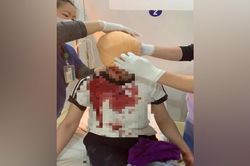 Cấp cứu bệnh nhân bị quấn tóc vào máy sao chè