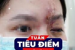 TIÊU ĐIỂM: Sức khỏe cô gái bị mù mắt vì tiêm filler môi, cằm, mũi ở tiệm cắt tóc; Con số của tuần: 292