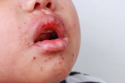 Căn bệnh truyền nhiễm hay tái đi tái lại ở trẻ