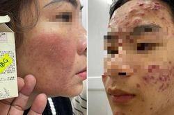 Nhiều người mặt như 'trận địa' vì sập bẫy làm đẹp cấp tốc đón Tết