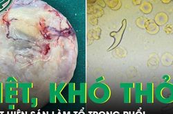 Mệt mỏi, đau ngực âm ỉ, đi khám phát hiện ấu trùng sán dây chó ký sinh tại phổi