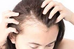 Gia tăng tình trạng rụng tóc ở giới trẻ do stress