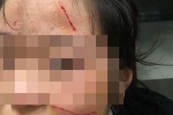 Thực hư thông tin nữ sinh Hà Nội bị rạch mặt tại trường học