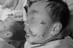Bé trai 3 tuổi bị chó hàng xóm cắn nát mặt