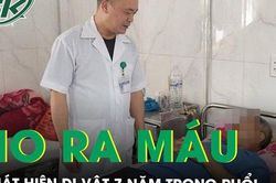 Đau ngực, ho khạc ra máu phát hiện dị vật tồn tại 7 năm trong phổi