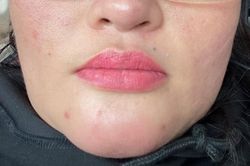 Tiêm độn cằm tại 1 spa, cô gái bị chảy mủ trong miệng