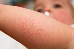 WHO cảnh báo số ca mắc sởi tăng 79% trên toàn cầu
