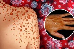 Tăng cường phòng, chống bệnh đậu mùa khỉ