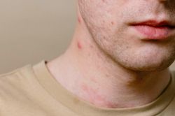 Ca nghi mắc đậu mùa khỉ đầu tiên tại Cà Mau