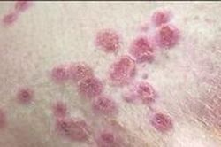 Cà Mau: Một trường hợp mắc bệnh đậu mùa khỉ