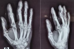 Cấp cứu thành công bệnh nhân gần đứt lìa ngón tay