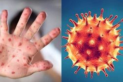 Kiên Giang ghi nhận 3 trường hợp mắc bệnh đậu mùa khỉ