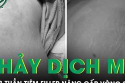 Vòng ba sưng đỏ, chảy dịch sau 3 tuần tiêm filler