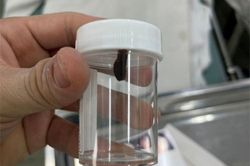 Con vắt sống trong hốc mũi bé gái suốt 10 ngày