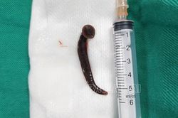 Đỉa sống dài hơn 5 cm nằm trong khí quản bệnh nhân 65 tuổi