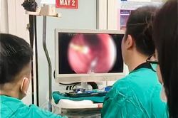 Bệnh nhi 8 tuổi nuốt kim diệt tủy răng sắc nhọn