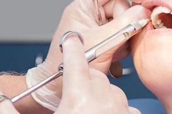 Nội soi thành công cho bệnh nhi 8 tuổi bị kim diệt tủy rơi vào đường tiêu hóa