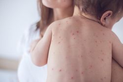 Số ca mắc bệnh sởi tăng đột biến trên toàn thế giới, Bộ Y tế khuyến cáo gì?