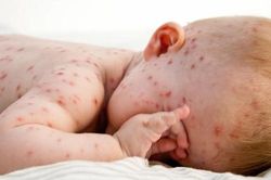 Ghi nhận 42 ca mắc bệnh sởi, Bộ Y tế đề nghị đẩy mạnh tiêm chủng