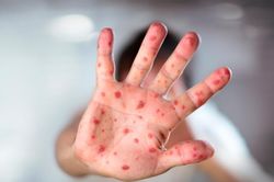 Bệnh sởi diễn biến bất thường, Bộ Y tế gửi công văn 'báo động'