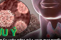 Dấu hiệu của ung thư tuyến giáp cần biết