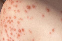 Nhiều ổ dịch thủy đậu xuất hiện: Cần làm gì để phòng tránh?