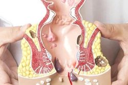 Bệnh trĩ có tự khỏi không, cần làm gì khi mắc trĩ?