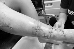 Phục hồi cổ chân bị đứt gân, mạch máu cho bé trai 10 tuổi