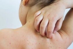 Hà Nội xuất hiện ca mắc rubella đầu tiên trong năm 2024