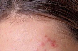 Làm thế nào để chăm sóc da dầu mụn nhạy cảm?