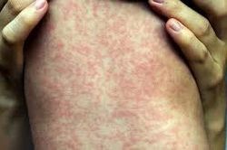 Phát hiện 2 ca mắc bệnh sởi, TPHCM kêu gọi phụ huynh cho trẻ tiêm vaccine