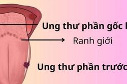 Người bệnh ung thư lưỡi nên tập luyện như thế nào?