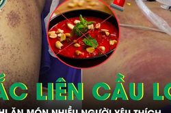 Mắc liên cầu lợn sau khi ăn món nhiều người yêu thích