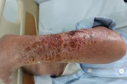 Người đàn ông bị nhiễm trùng ở da và mô dưới da sau khi bị mèo cào