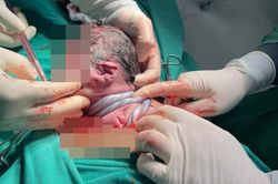Em bé chào đời với dây rốn quấn 3 vòng cổ