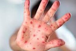 Nghệ An có 45 ca mắc bệnh sởi, nguy cơ bùng phát trên diện rộng