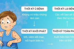 Bệnh sởi lây lan nhanh, trẻ nhỏ có thể tử vong vì biến chứng
