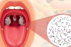 Chẩn đoán, điều trị bệnh bạch hầu kịp thời