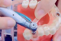 Máng hướng dẫn phẫu thuật Guideline - Bí quyết trồng răng implant an toàn, không biến chứng