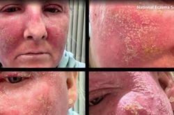 Da nuôi cấy mang lại hy vọng cho người mắc bệnh chàm