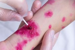 Nhiều trẻ sơ sinh lây thủy đậu từ mẹ