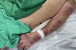 Mua thủ lợn về chế biến, người đàn ông mắc liên cầu nguy kịch