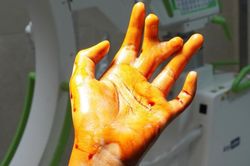 Phẫu thuật thành công dị tật thừa ngón tay cho bệnh nhi 11 tuổi