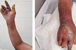 Tự dùng thuốc tại nhà khi bị chó cắn, bệnh nhân bị nhiễm khuẩn huyết