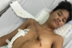 Cứu sống bệnh nhân rách toác ngực do tai nạn giao thông