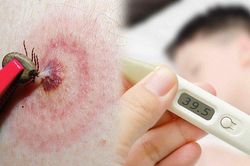 Các câu hỏi thường gặp liên quan đến sốt ve mò