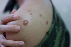 Đậu mùa khỉ đáng ngại thế nào WHO lại mở họp khẩn?