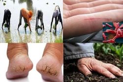 Vi khuẩn ăn thịt người tấn công 4 bệnh nhân