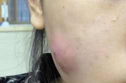 Nữ bệnh nhân suýt hoại tử vùng mặt do... tự nặn mụn ở nhà