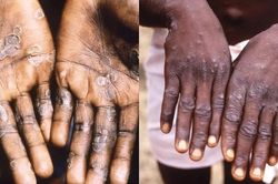 Congo hy vọng sớm nhận vắc xin đậu mùa khỉ